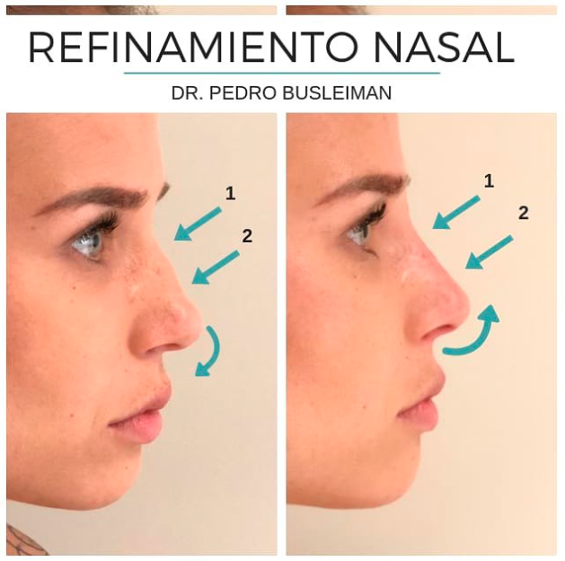 Resultado de rinoplastia